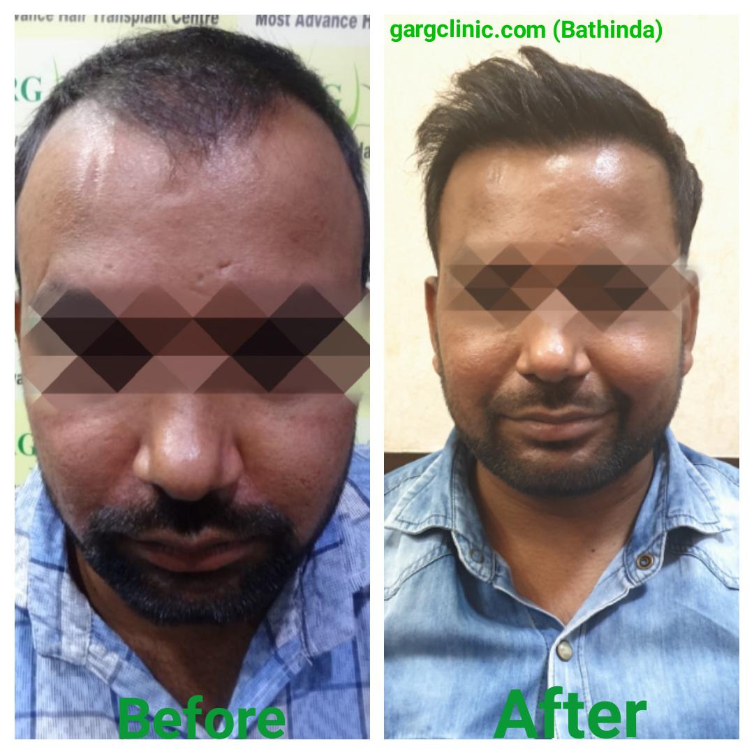 Garg Hair Transplant Clinic