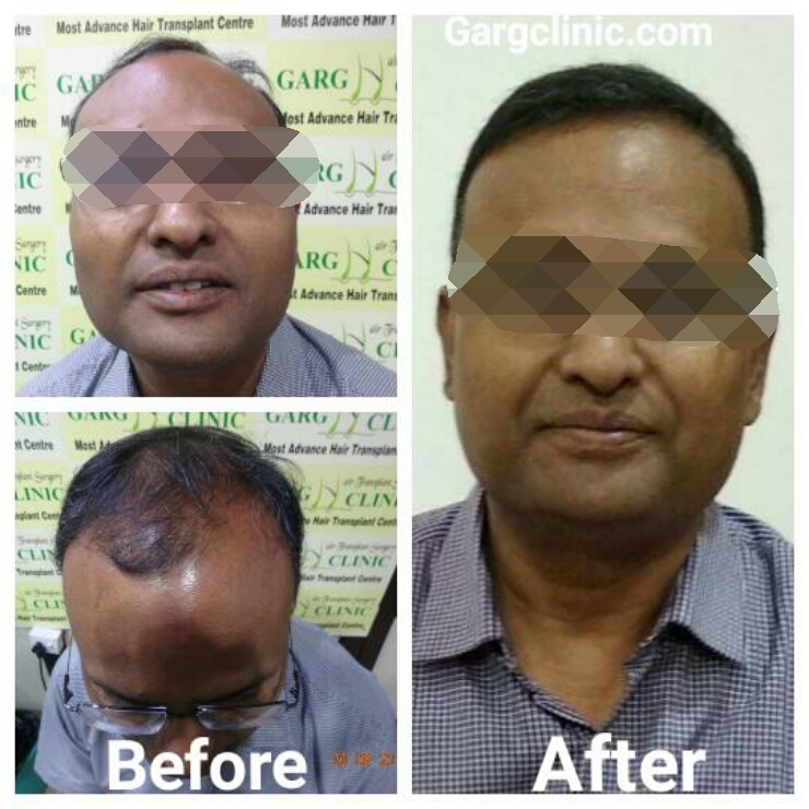 Garg Hair Transplant Clinic