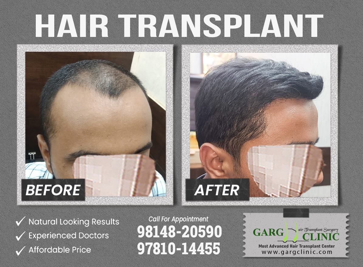 Garg Hair Transplant Clinic