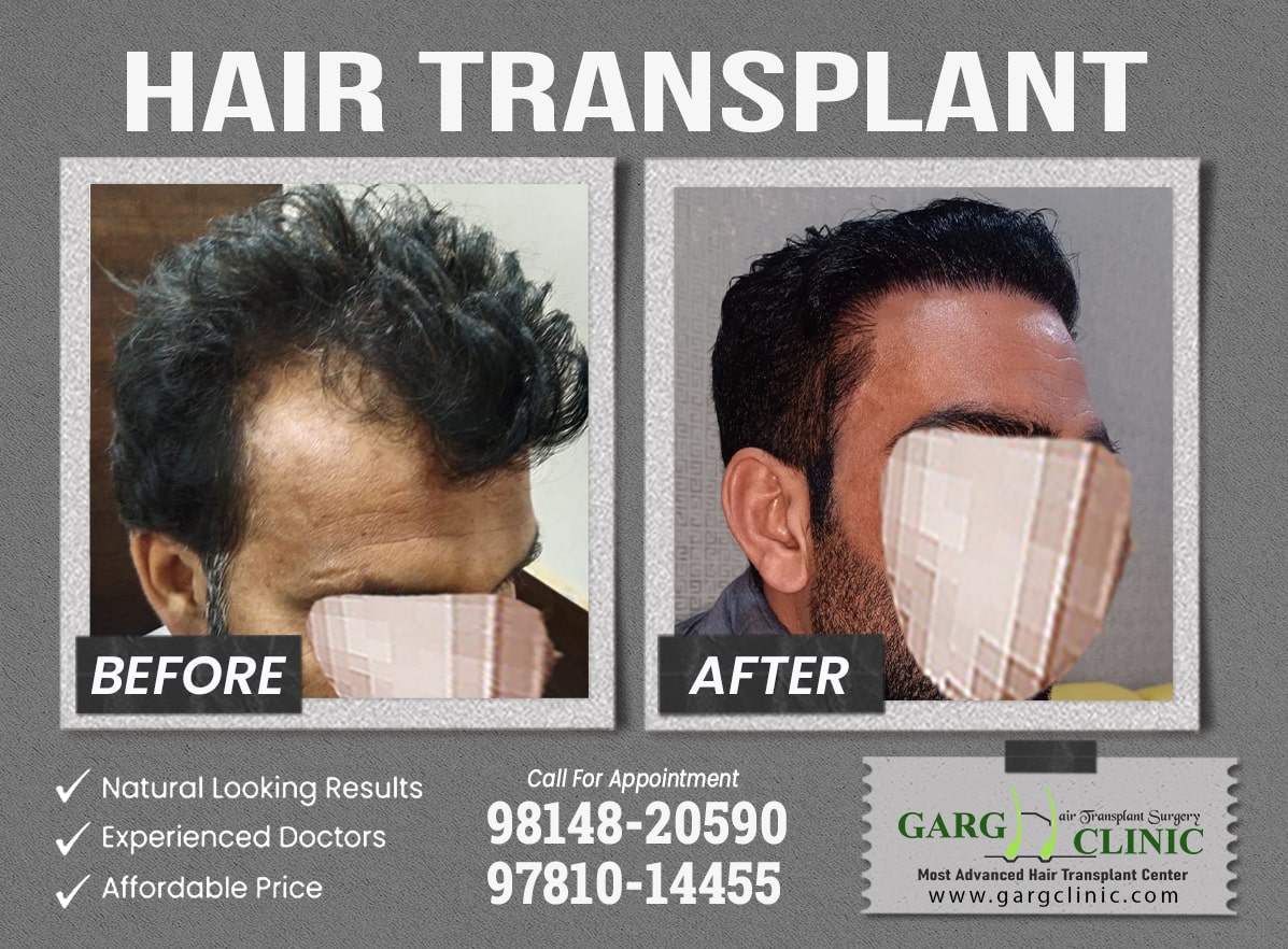 Garg Hair Transplant Clinic
