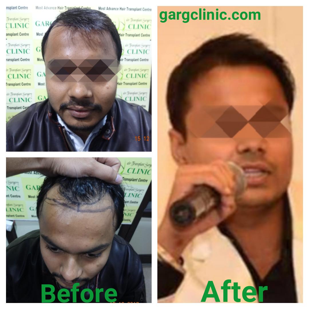 Garg Hair Transplant Clinic