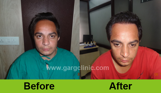 Garg Hair Transplant Clinic