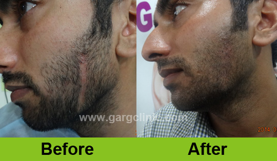 Garg Hair Transplant Clinic