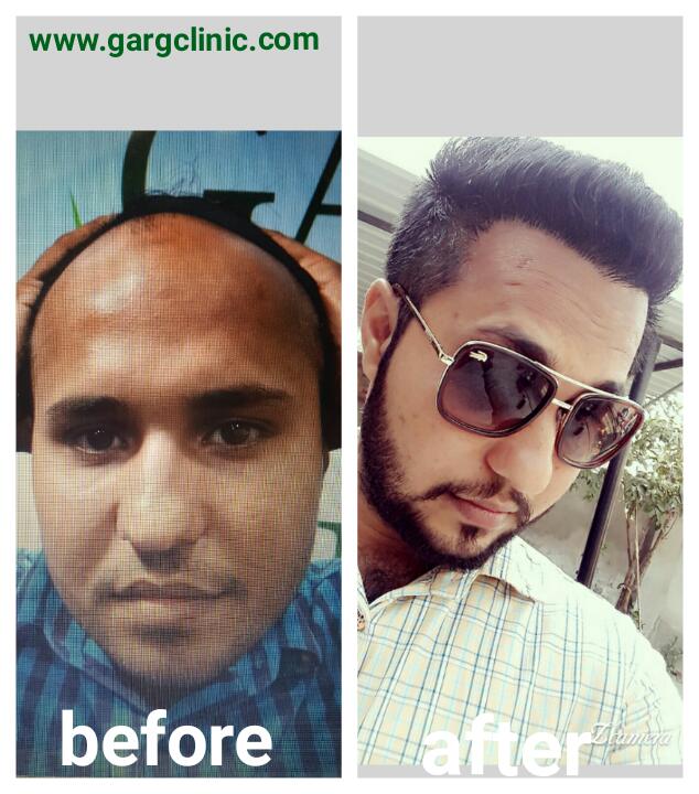 Garg Hair Transplant Clinic