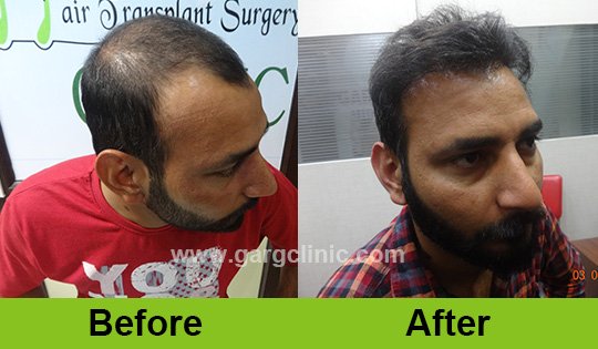 Garg Hair Transplant Clinic