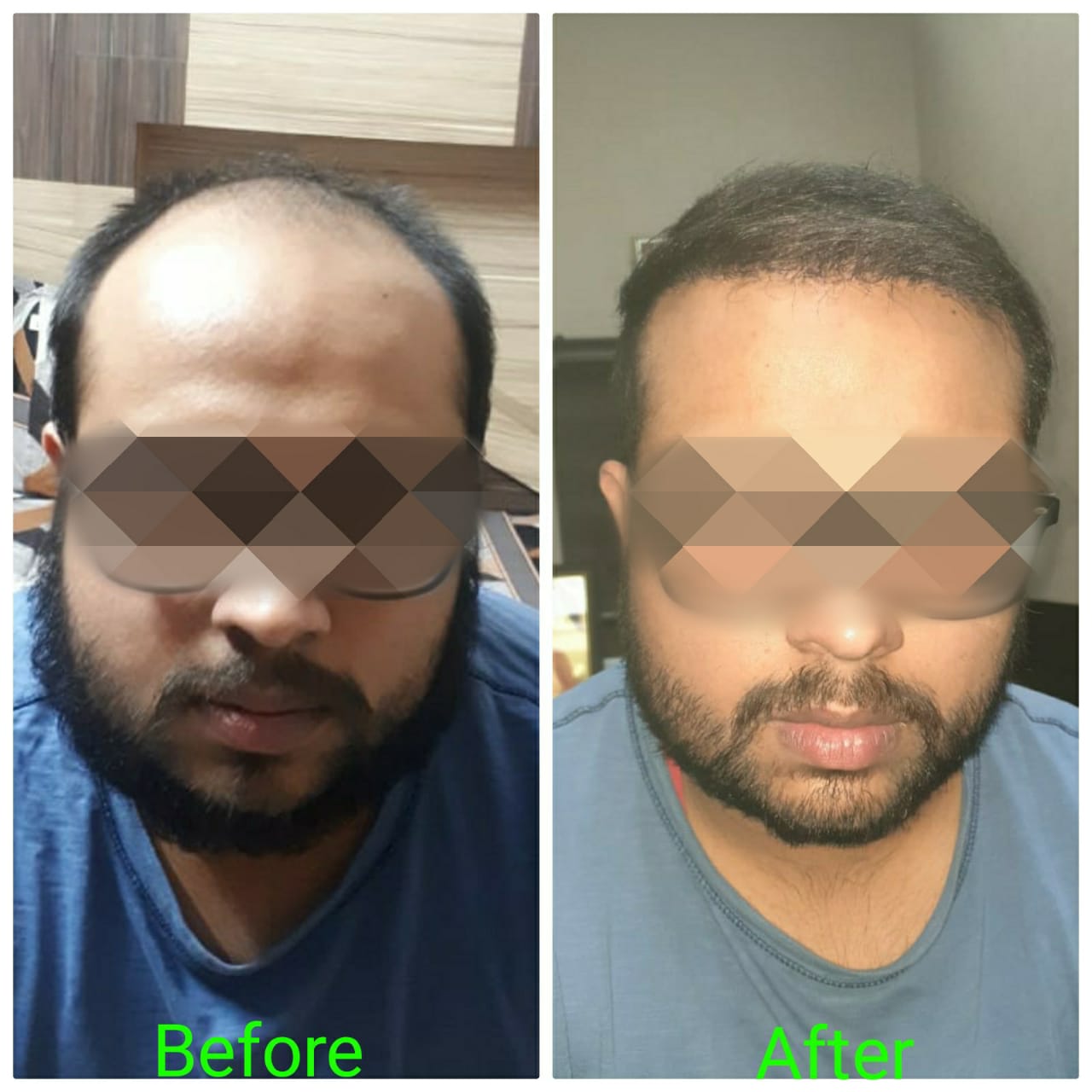 Garg Hair Transplant Clinic