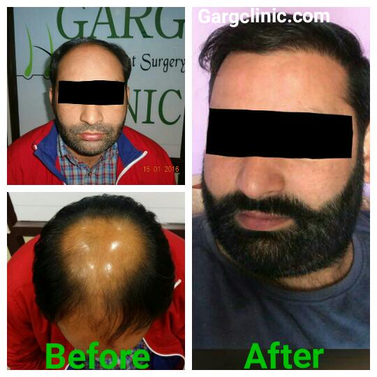 Garg Hair Transplant Clinic