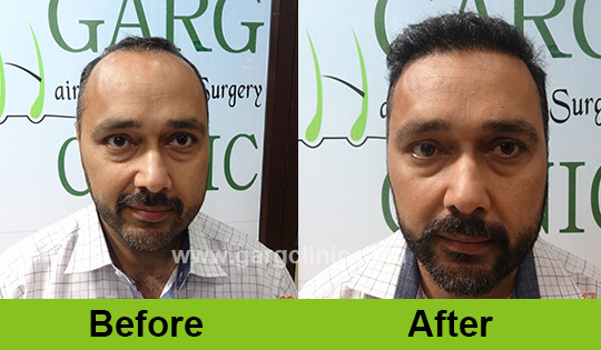 Garg Hair Transplant Clinic
