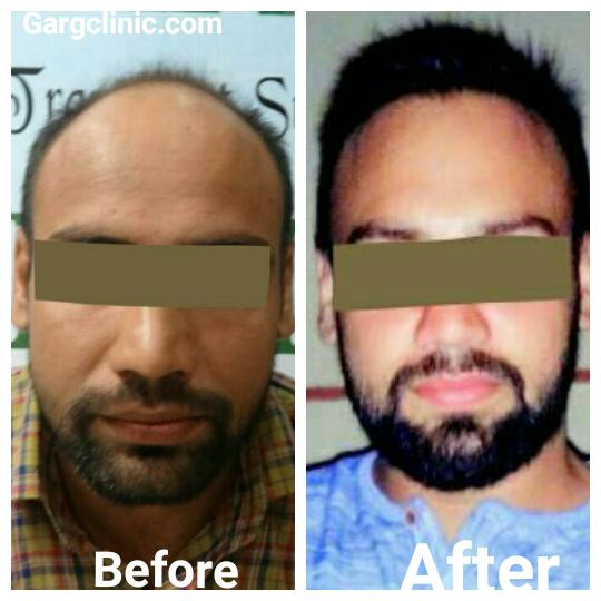 Garg Hair Transplant Clinic