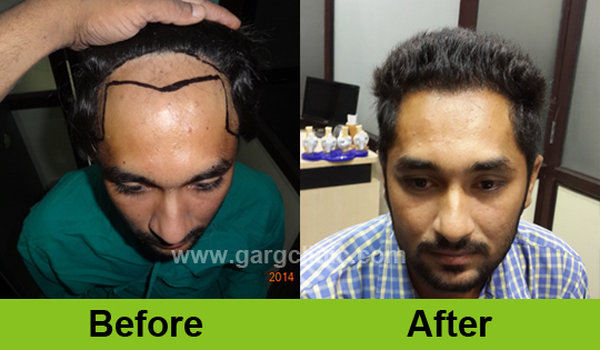 Garg Hair Transplant Clinic