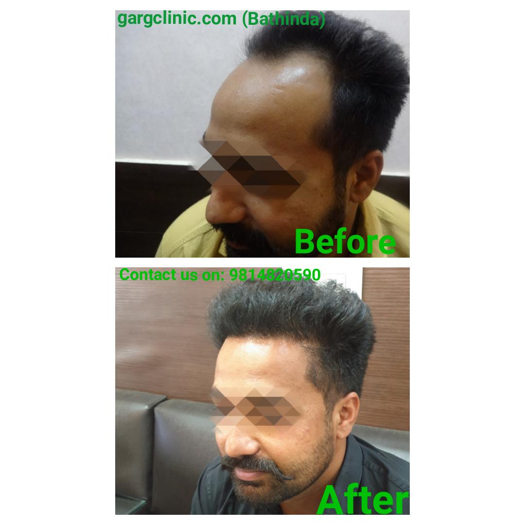 Garg Hair Transplant Clinic