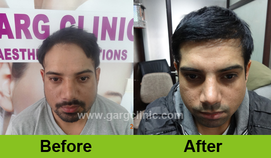 Garg Hair Transplant Clinic