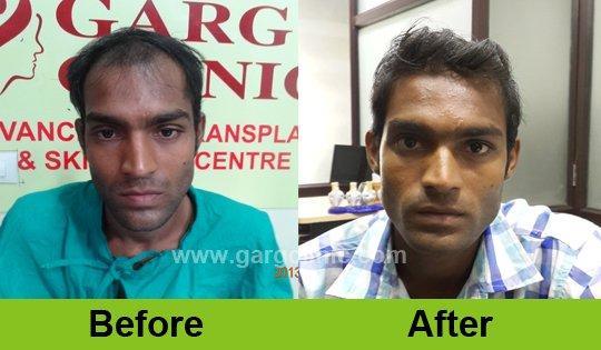 Garg Hair Transplant Clinic