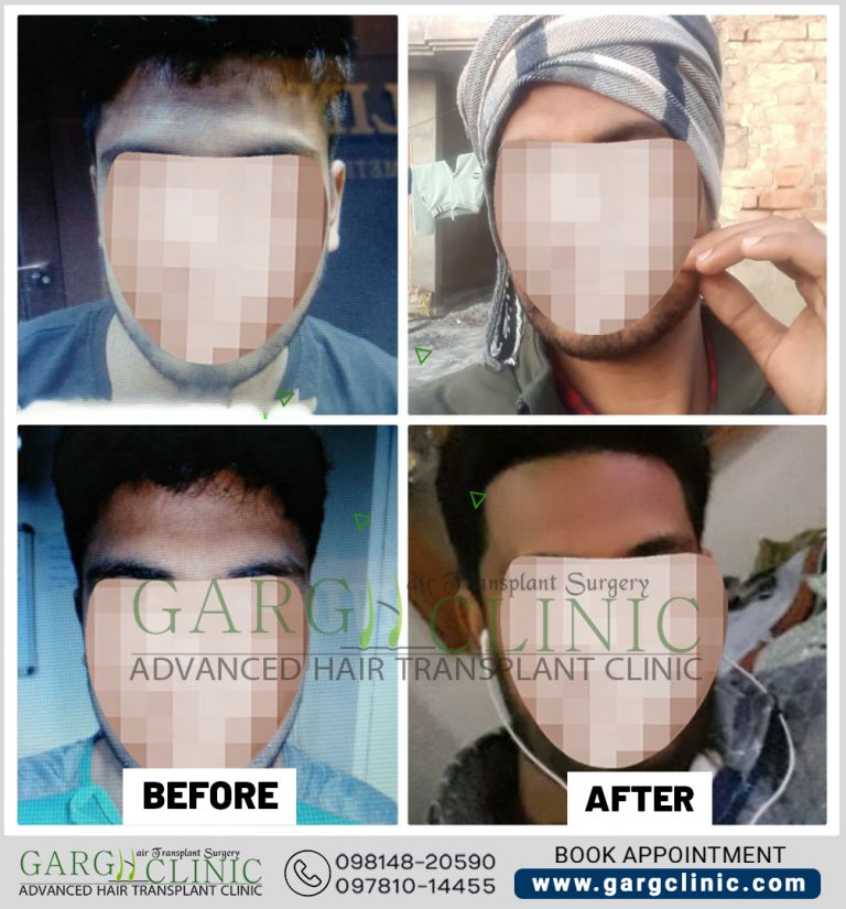 Garg Hair Transplant Clinic