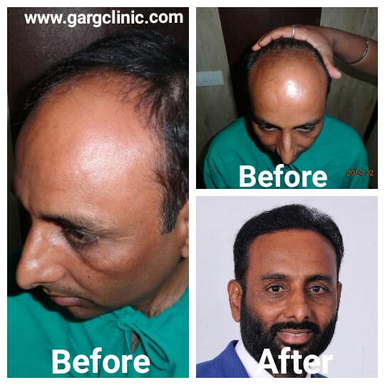 Garg Hair Transplant Clinic