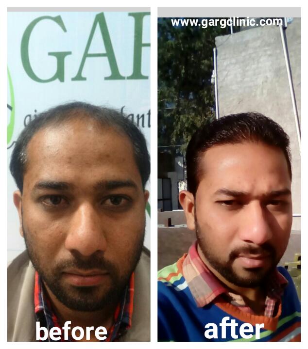 Garg Hair Transplant Clinic