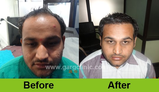 Garg Hair Transplant Clinic