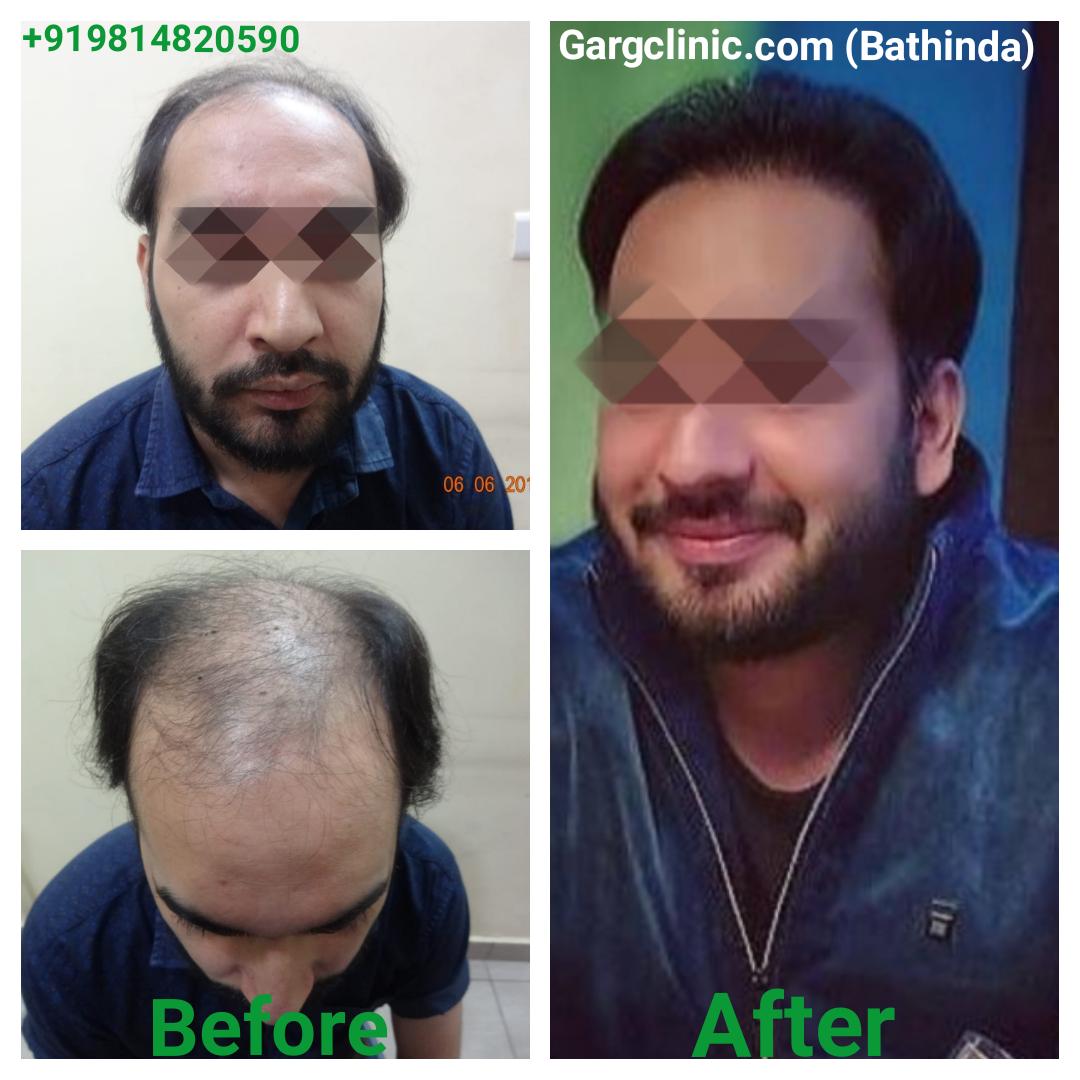 Garg Hair Transplant Clinic