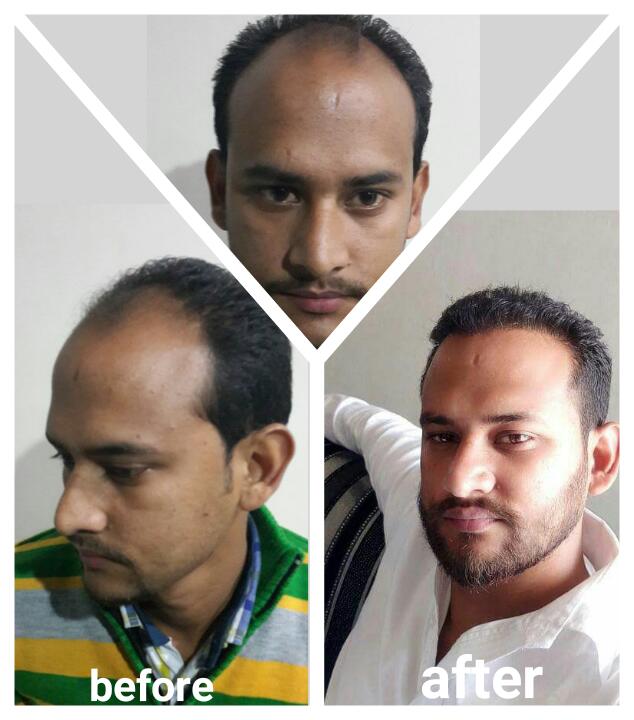 Garg Hair Transplant Clinic