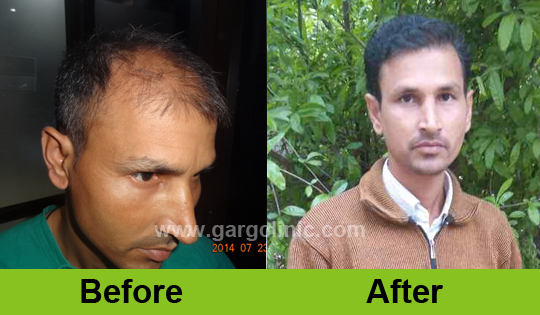 Garg Hair Transplant Clinic