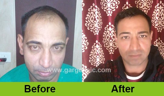 Garg Hair Transplant Clinic