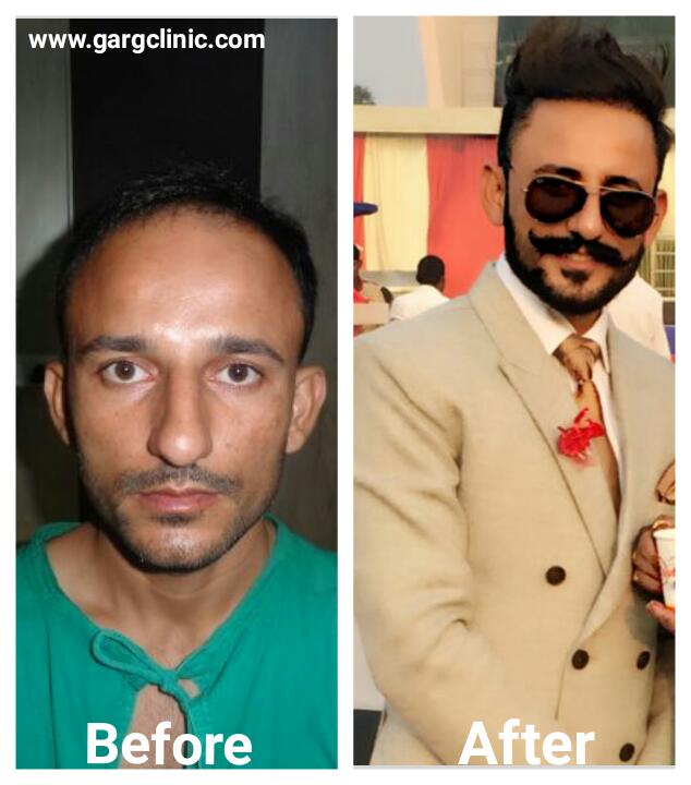 Garg Hair Transplant Clinic