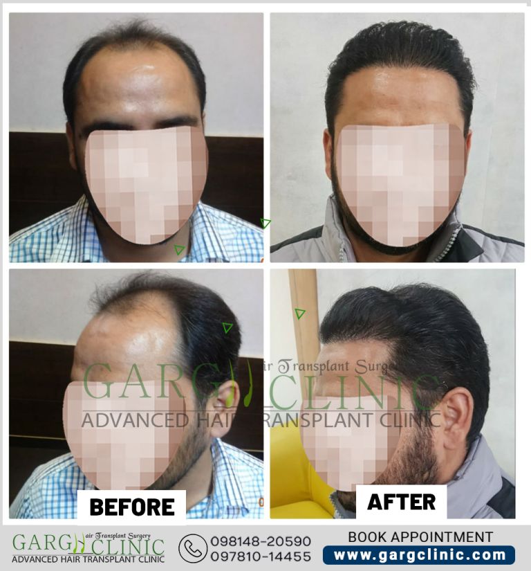 Garg Hair Transplant Clinic