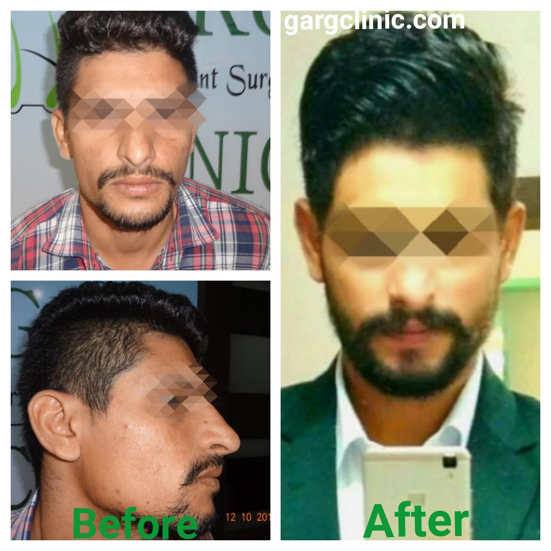 Garg Hair Transplant Clinic