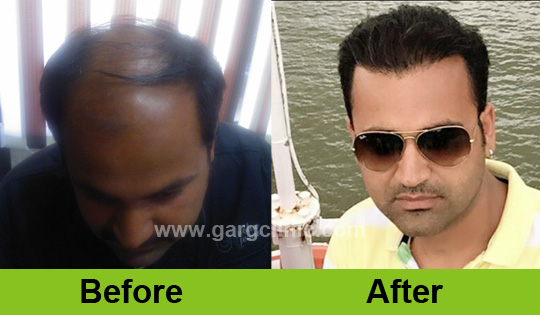 Garg Hair Transplant Clinic