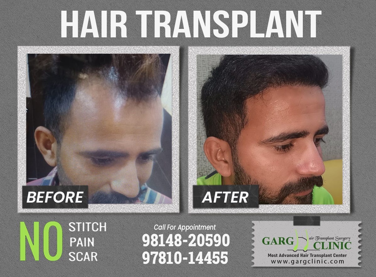 Garg Hair Transplant Clinic