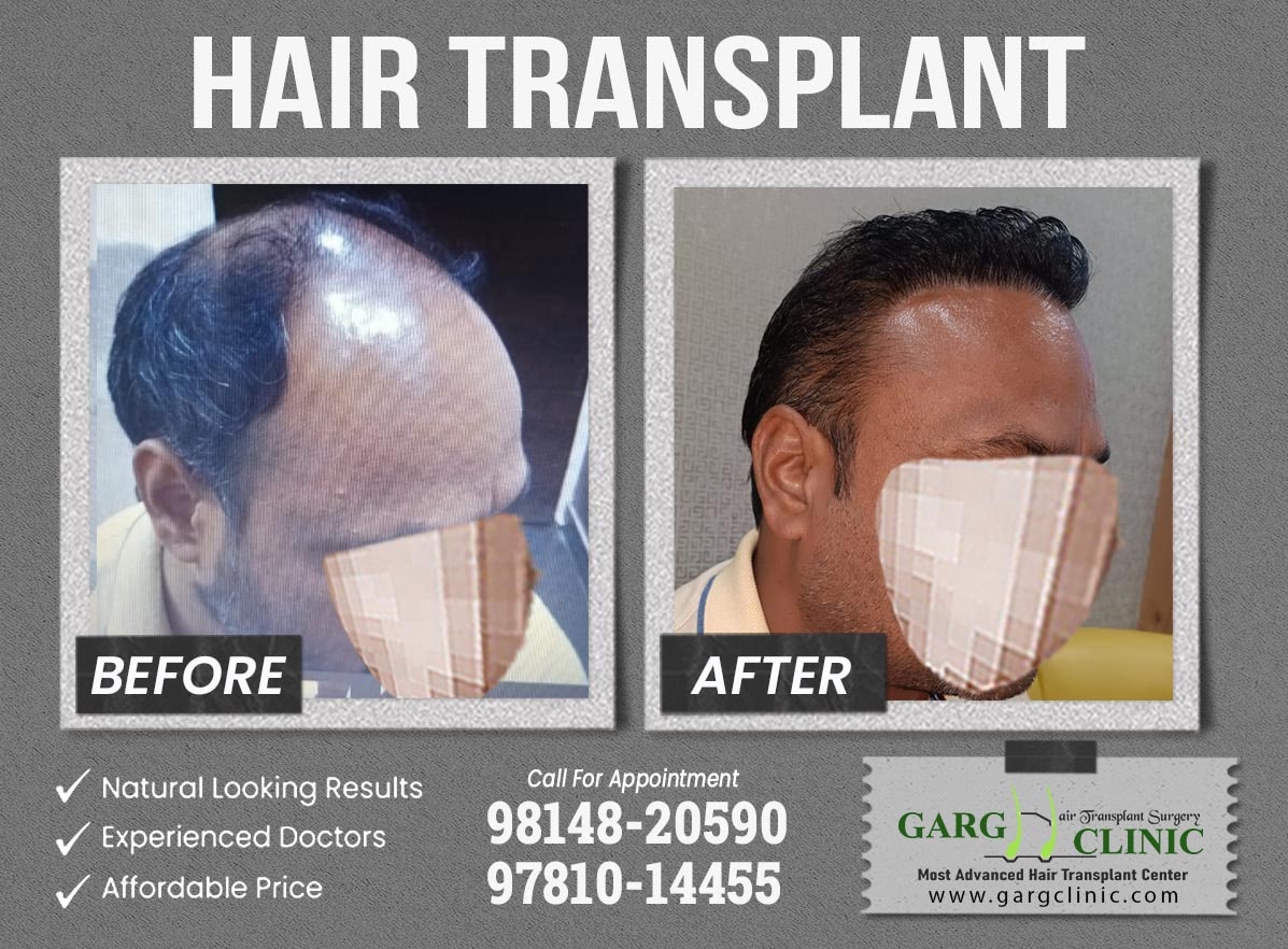 Garg Hair Transplant Clinic