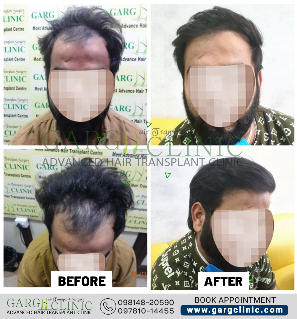 Garg Hair Transplant Clinic