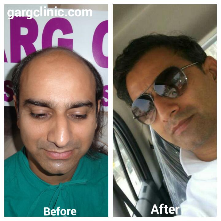 Garg Hair Transplant Clinic