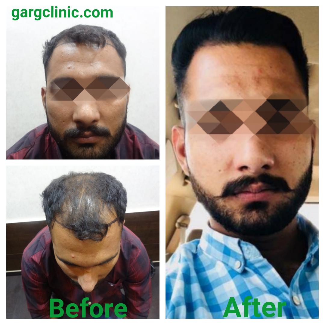 Garg Hair Transplant Clinic