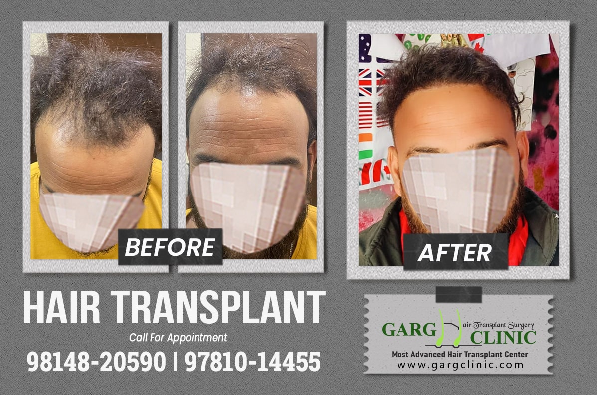 Garg Hair Transplant Clinic
