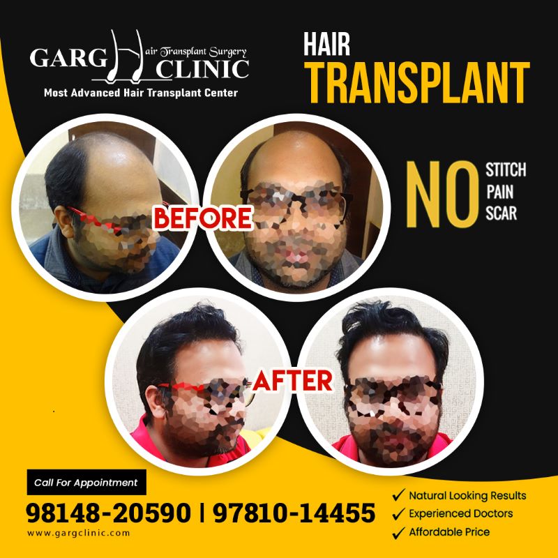Garg Hair Transplant Clinic