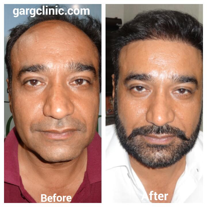 Garg Hair Transplant Clinic