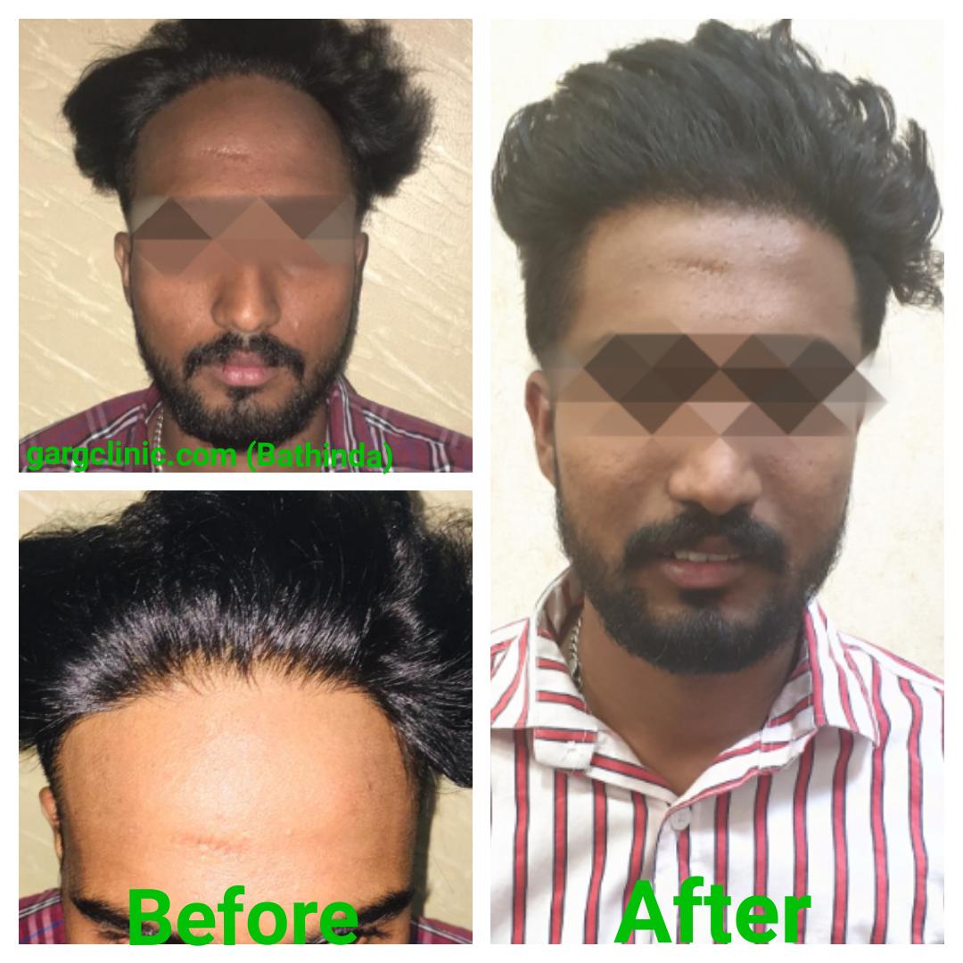 Garg Hair Transplant Clinic