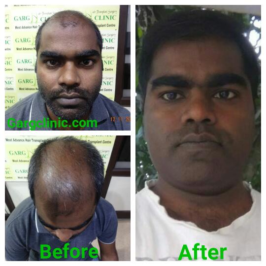 Garg Hair Transplant Clinic
