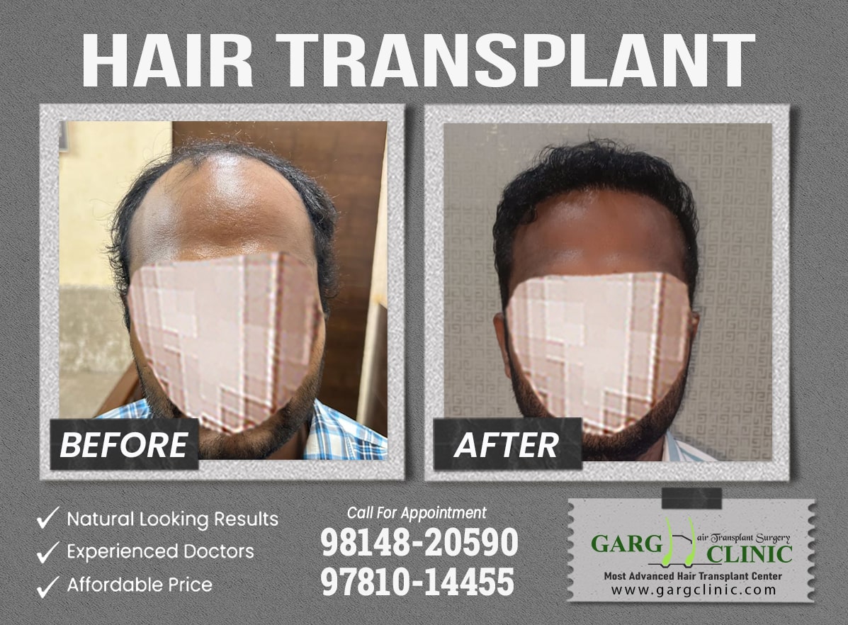 Garg Hair Transplant Clinic