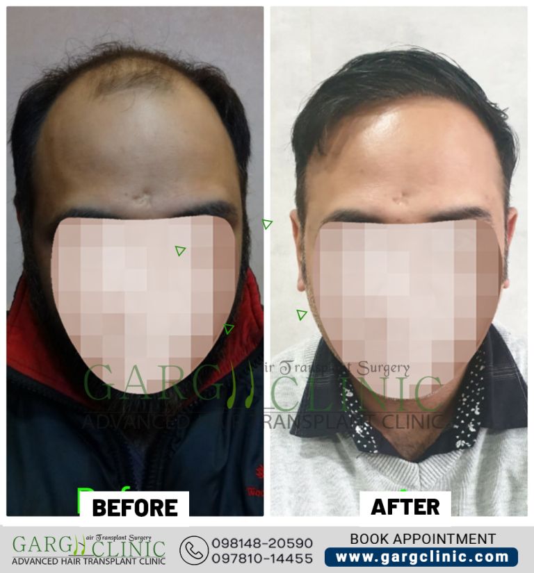 Garg Hair Transplant Clinic