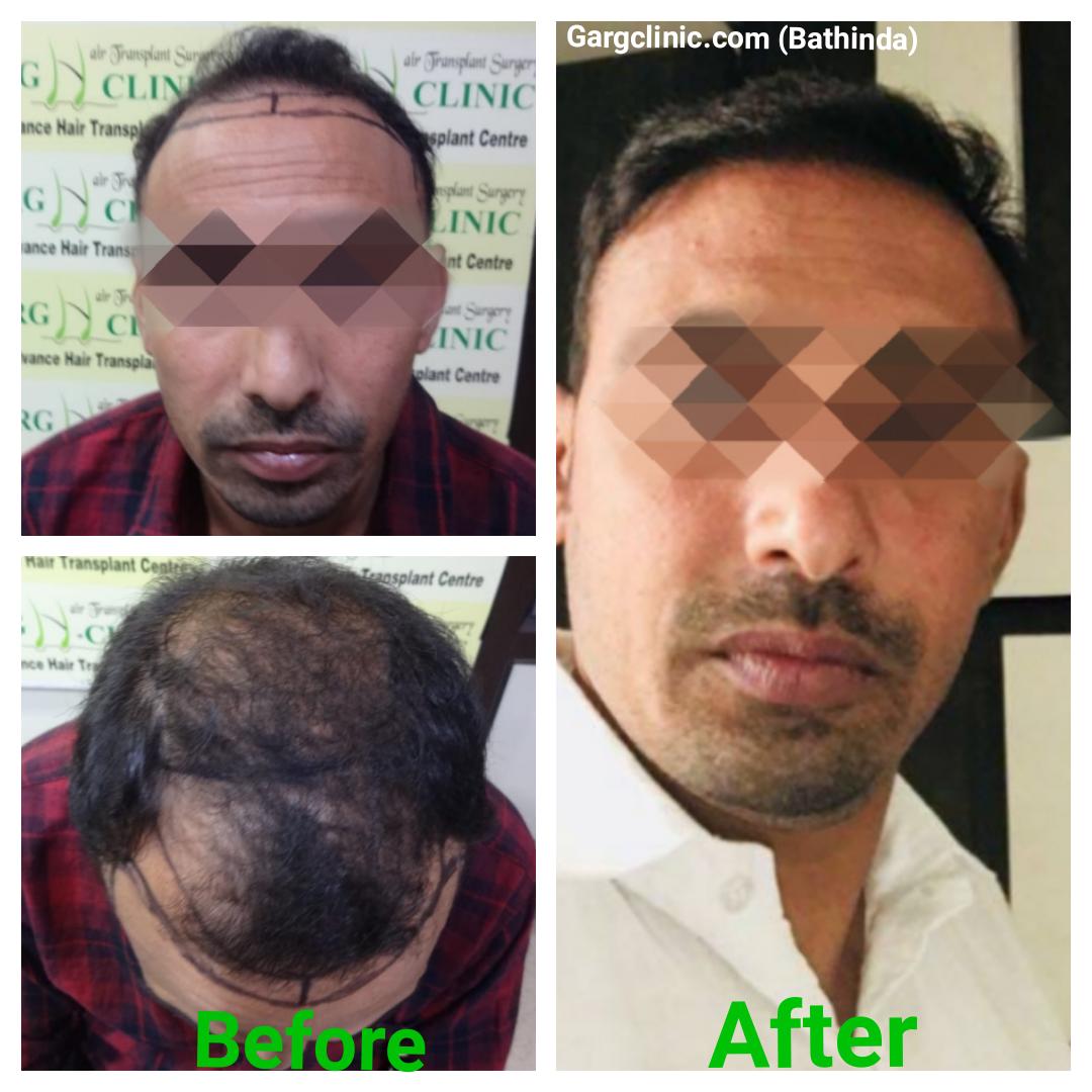 Garg Hair Transplant Clinic