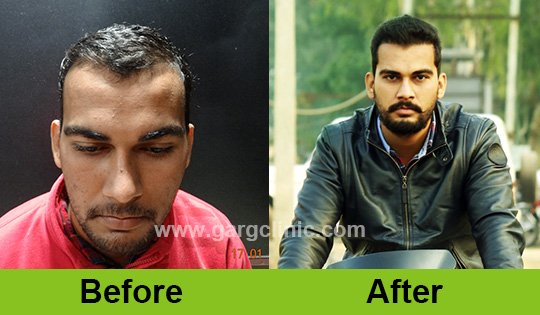 Garg Hair Transplant Clinic