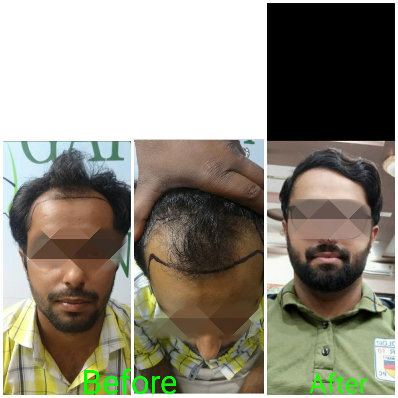 Garg Hair Transplant Clinic