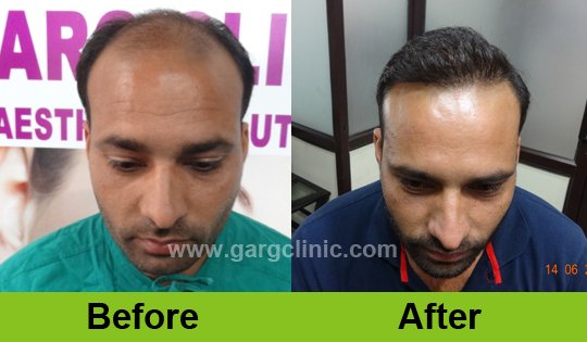 Garg Hair Transplant Clinic
