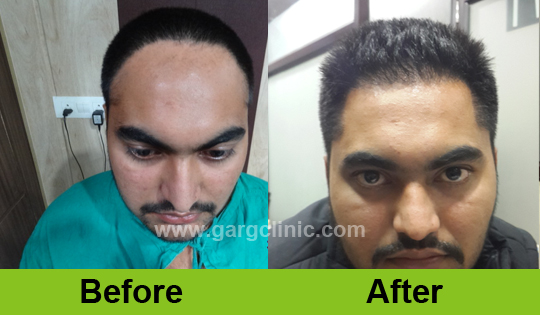 Garg Hair Transplant Clinic