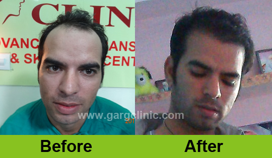 Garg Hair Transplant Clinic