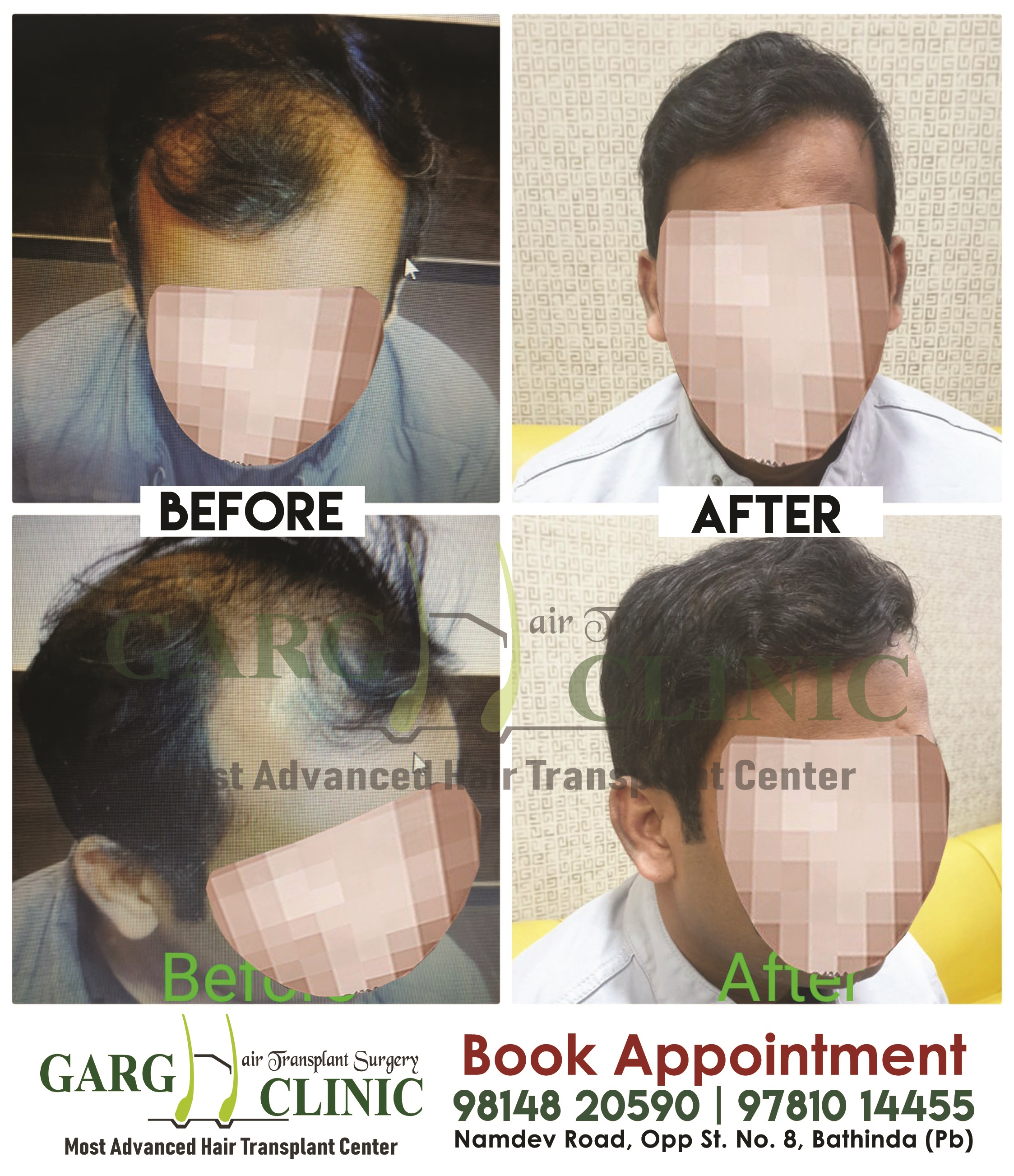Garg Hair Transplant Clinic