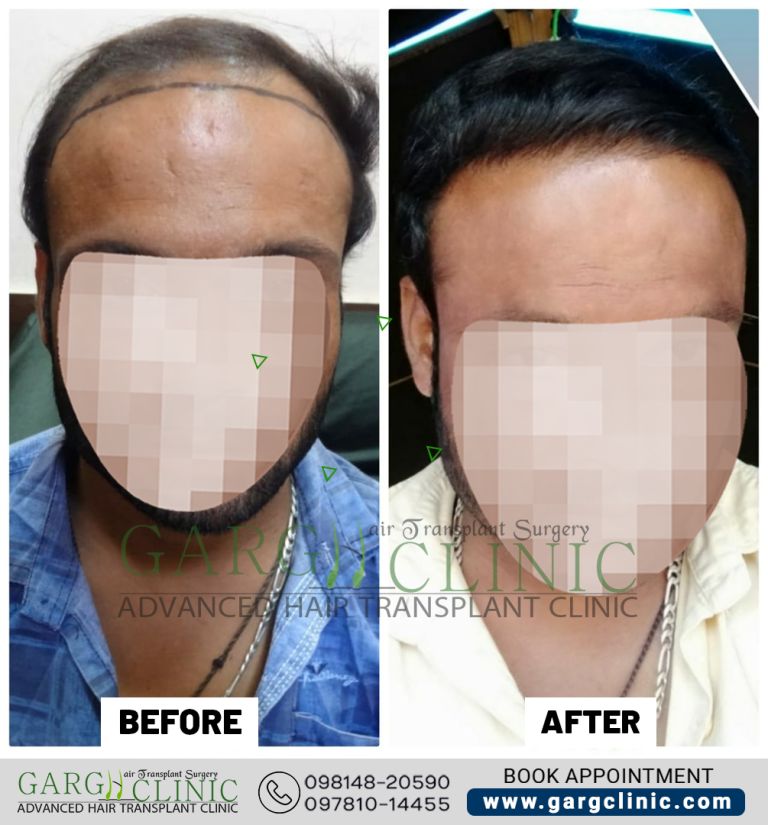 Garg Hair Transplant Clinic
