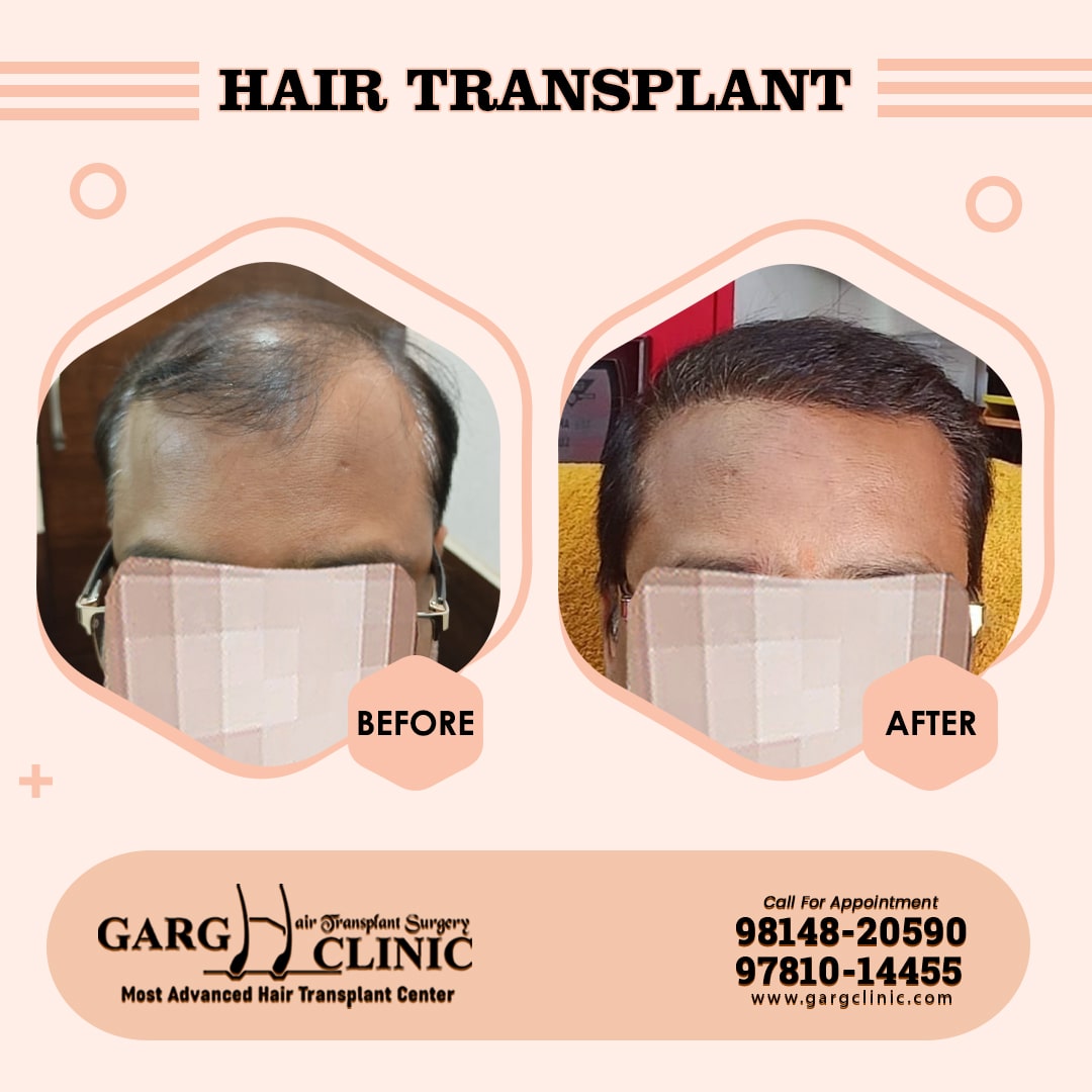 Garg Hair Transplant Clinic